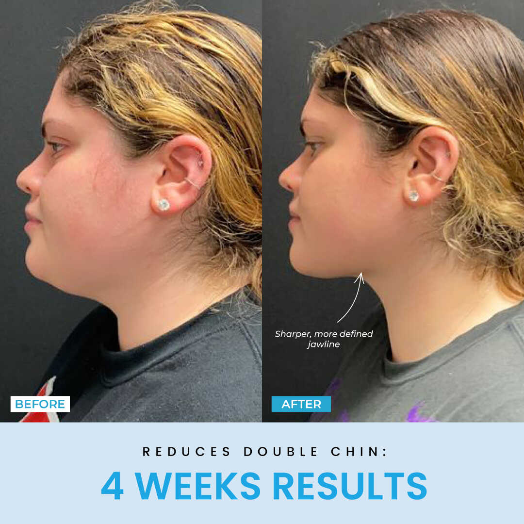 LiftLab Sculptor + Free Serum